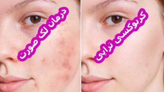 کربن تراپی برای لک صورت