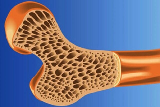 پوکی استخوان در نیمی از جمعیت کشور / وضعیت دستگاه های سنجش تراکم استخوان