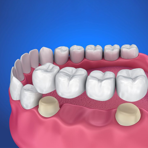 مزایا و معایب بریج دندان چیست؟ | نکات مهم قبل از بریج دندان