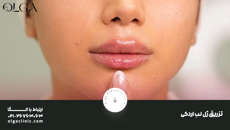 تزریق ژل | تزریق ژل لب تزریق ژل لب اردکی چیست؟